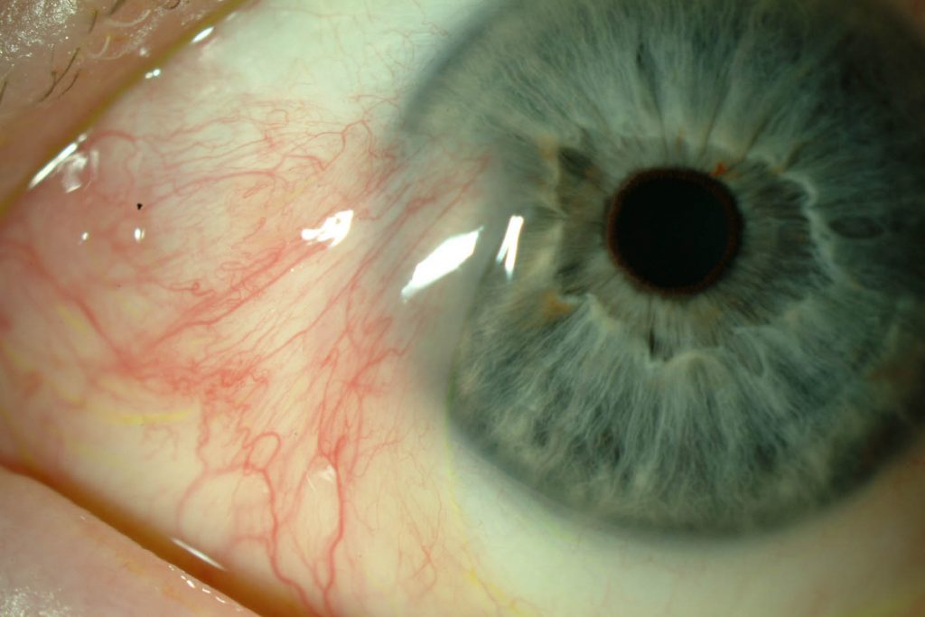 A close up photo of an eye with red blood vessels